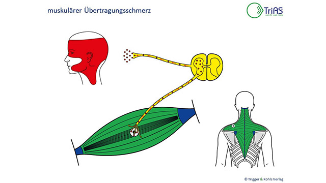 muskulärer Übertragungsschmerz