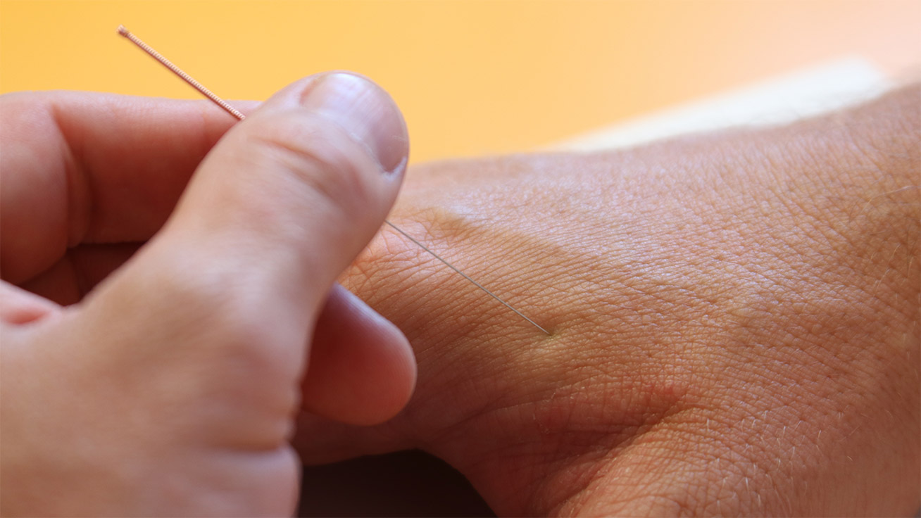 Akupunkturnadel abductor pollicis